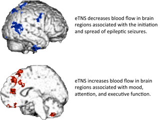 TNS Blood Flow